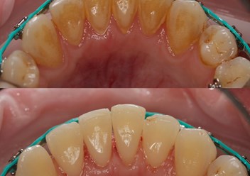 Чистка зубов при брекет-системе