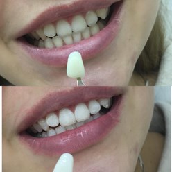 Сет 20 минут. Осветление на 4-6 тонов