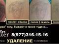 Фото компании  Лазерное удаление татуировок и татуажа 3