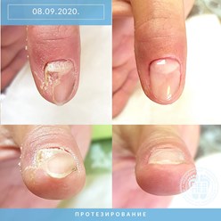 Протезирование ногтя