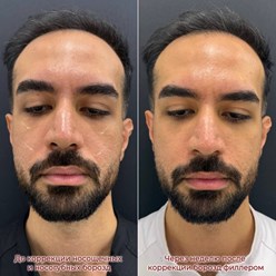 Контурная пластика