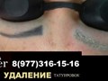 Фото компании  Лазерное удаление татуировок и татуажа 5