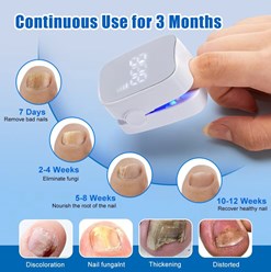 Лампа от грибка ногтей NAIL FUNGUS LASER DEVICE