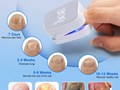 Лампа от грибка ногтей NAIL FUNGUS LASER DEVICE