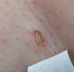 Фото сразу после удаления новообразования кожи на теле в Кемерово