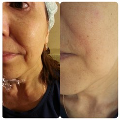 Коррекция носогубки холодной плазмой