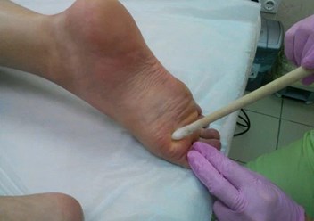 Удаление шипиц на стопе жидким азотом в Кемерово