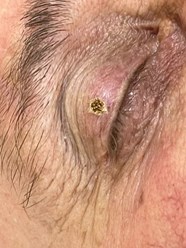 Удаление новообразований на веке в Кемерово