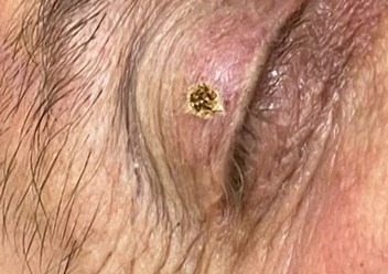 Удаление новообразований на веке в Кемерово