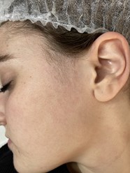 Электроэпиляция веска фото ДО