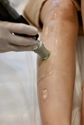 Лазерная эпиляция на александритовом лазере Deka Moveo