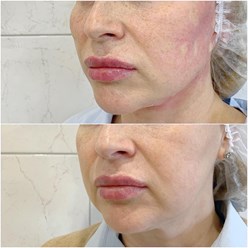 Постановка лифтинговых нитей.