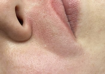 Электроэпиляция верхней губы фото ПОСЛЕ