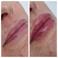 Эстетическое изменение формы губ