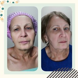 безинъекционная подтяжка лица