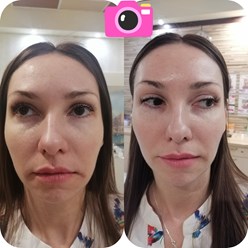 Сеанс лифтинг массажа фото до/после