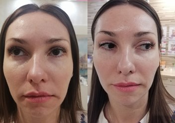 Сеанс лифтинг массажа фото до/после