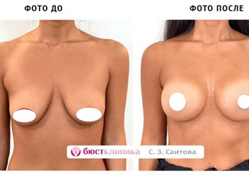 Фото До и После подтяжки груди с увеличением