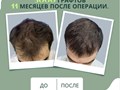 Примеры наших работ в трихологической клинике. Пересадка волос за 1 день. Бесшовный метод.