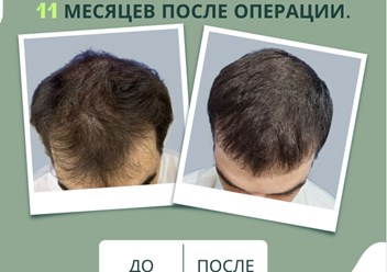 Примеры наших работ в трихологической клинике. Пересадка волос за 1 день. Бесшовный метод.