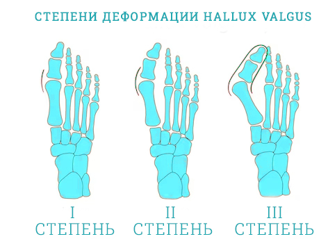 Как избавиться от косточки на ноге ?