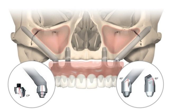 Виды протезирования зубов