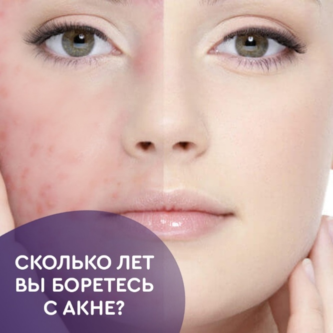 Лечение акне Лечение акне