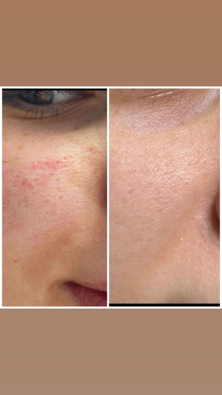 Выравнивание цвета кожи, устранение дефектов, омоложение.