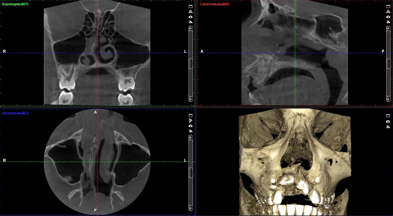 Кт лицевых костей. Компьютерная томография лицевого скелета.