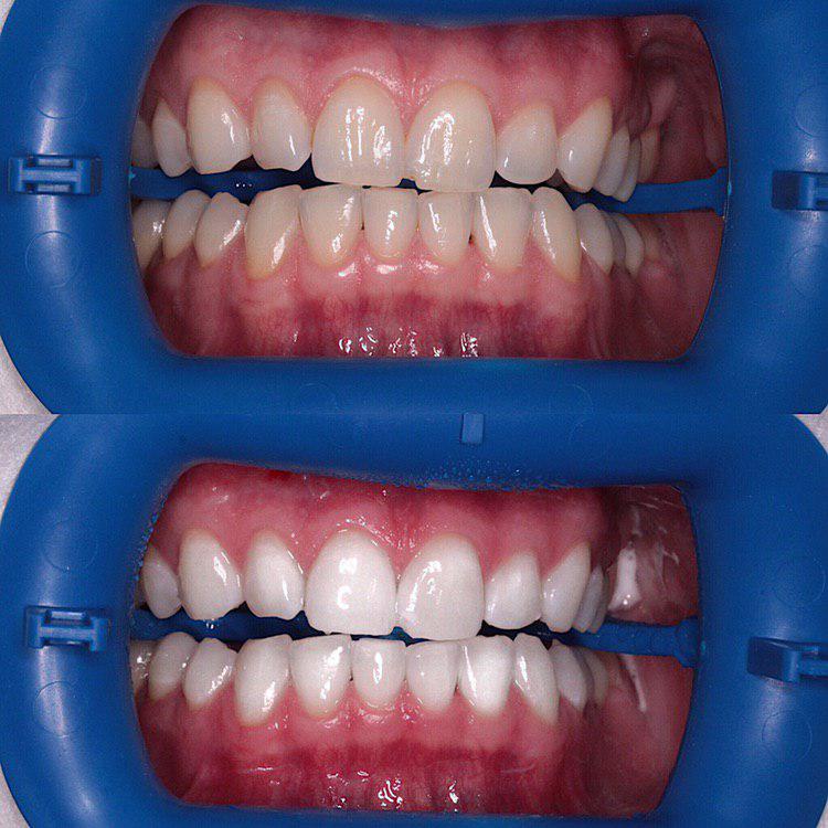 3д отбеливание зубов зум
