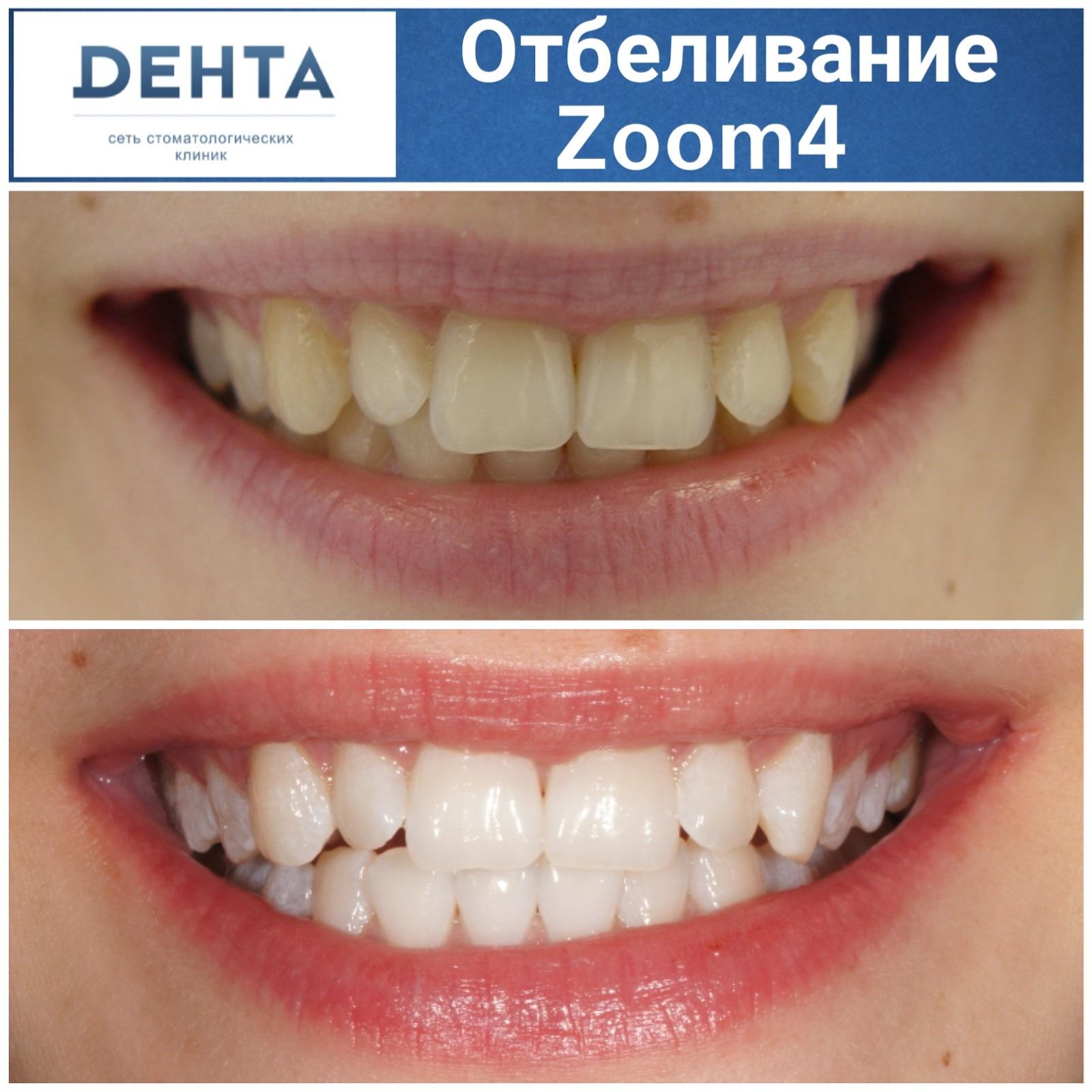 Чистка зубов казань акции. Отбеливание зубов результат. Зубы до и после отбеливания.