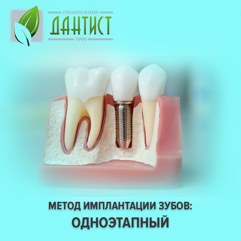 имплант зуба магнитогорск. циркониевый абатмент нобель. акция на имплантацию зубов. абатмент нобель 36834. двухэтапная имплантация.