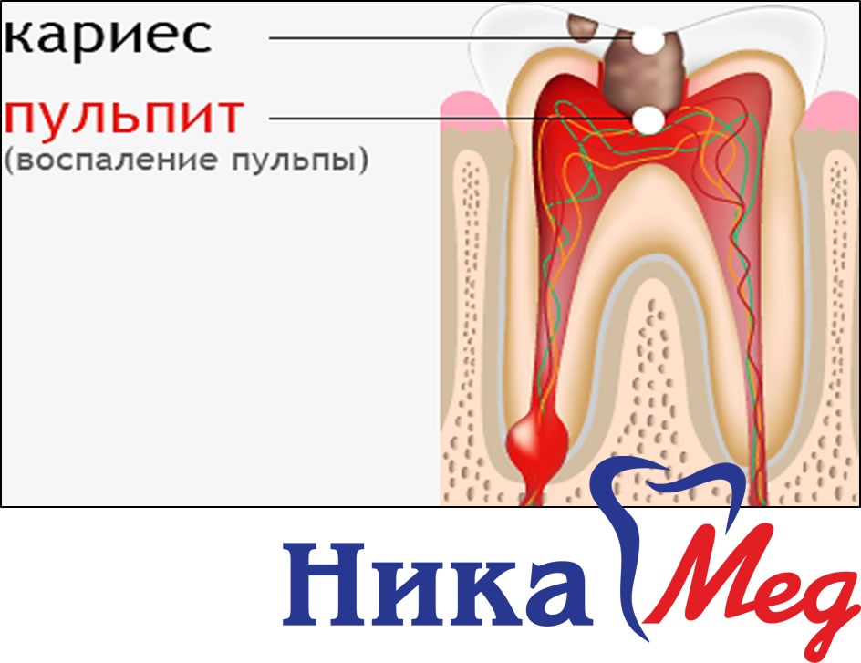 Удаление нерва зуба схема