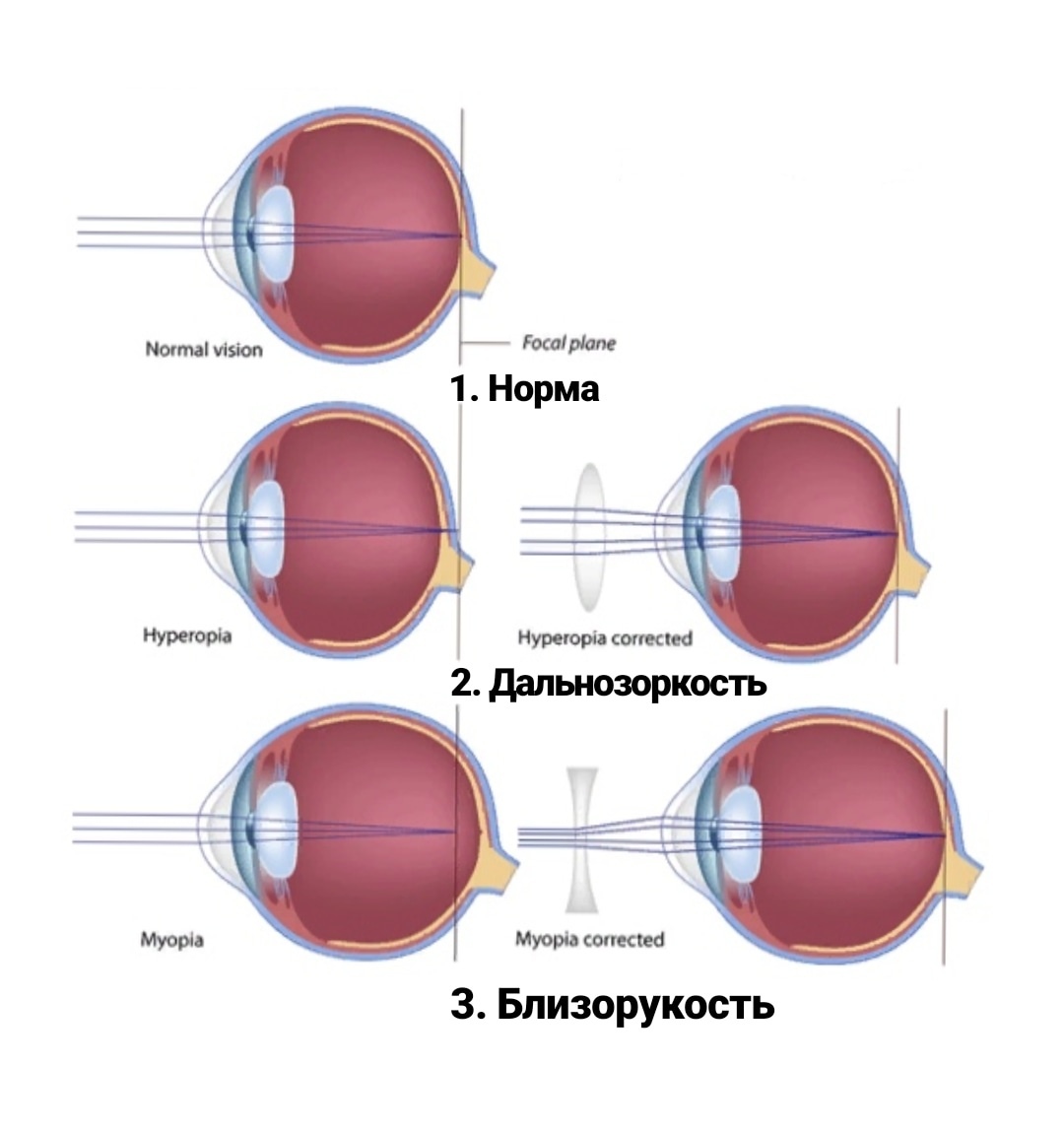 Близорукость и дальнозоркость фото
