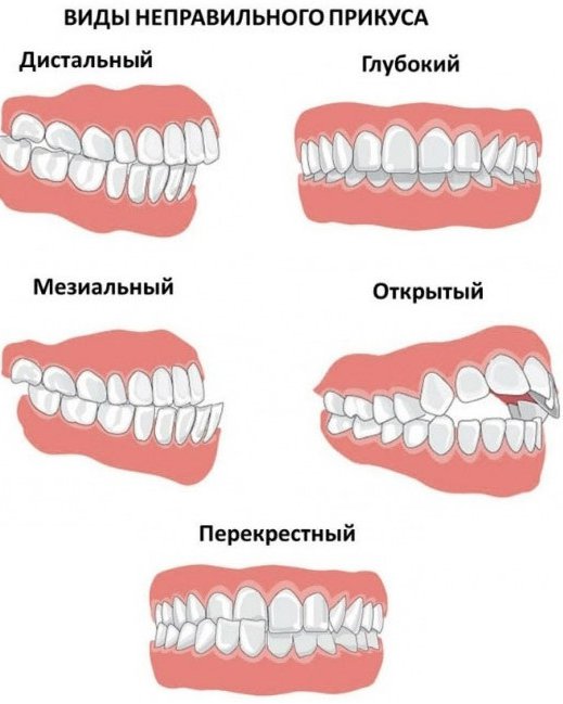 Опистогнатический прикус картинки